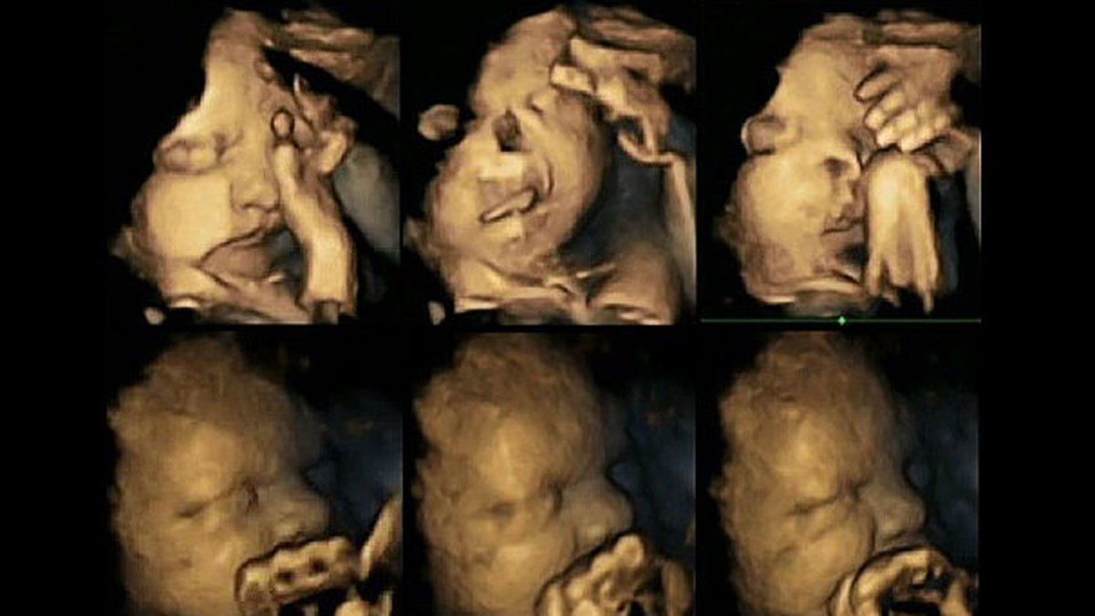 Jämförande bilder visar foster till mammor som röker och inte. 